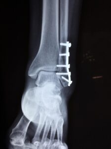 Home Orthopedie in Tiel biedt deskundige zorg en innovatieve behandelingen voor bewegingsvrijheid en herstelling van patiënten